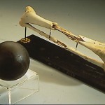 During the Battle of Gettysburg, on July 2, 1863, Union General Daniel Sickles's lower right leg was shattered by a cannonball, such as the one in the image. After his leg (above) was amputated, Sickles sent it to the Army Medical Museum in Washington, where it was preserved. Sickles often visited his leg on the anniversary of the amputation. (National Museum of Health and Medicine)